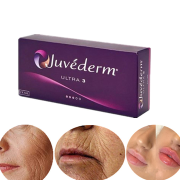 2 X 1 ML JUVEDERM ULTRA 3 Lips Augmentation Cross Linked Dermal Filler